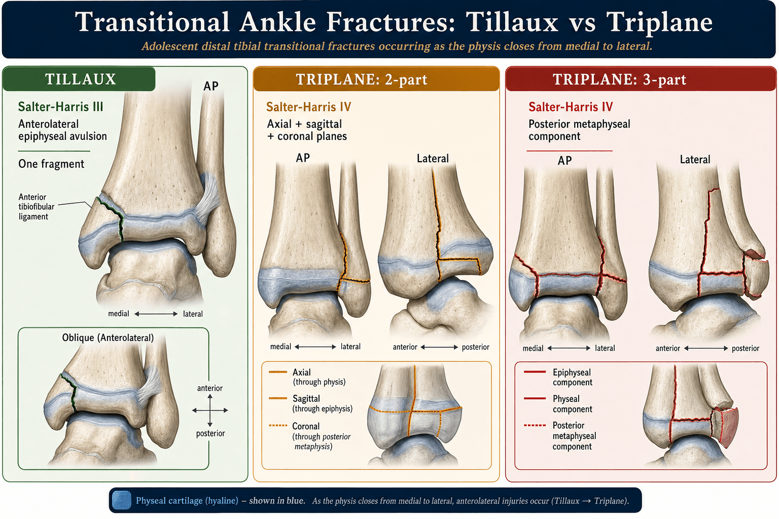 Classification diagram of Tillaux versus triplane transitional ankle fractures by Salter-Harris type