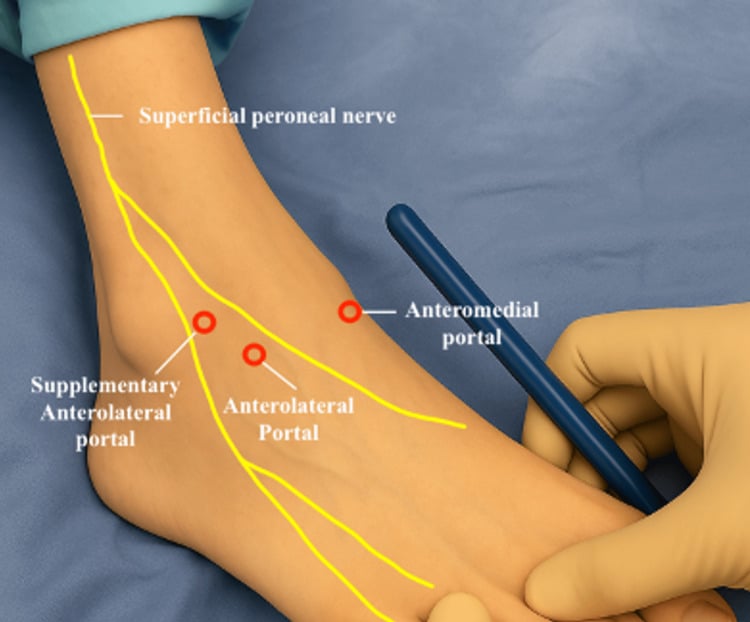 Surface anatomy of anteromedial, anterolateral and supplementary anterolateral ankle arthroscopy portals relative to the superficial fibular nerve.