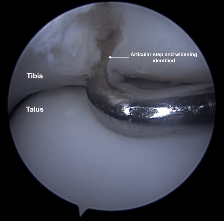 Ankle arthroscopy showing a displaced distal tibial articular fracture step above the talar dome.