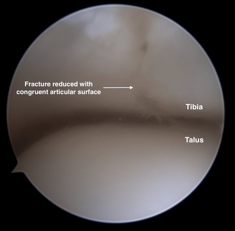 Ankle arthroscopy after reduction showing a congruent distal tibial plafond over the talar dome.