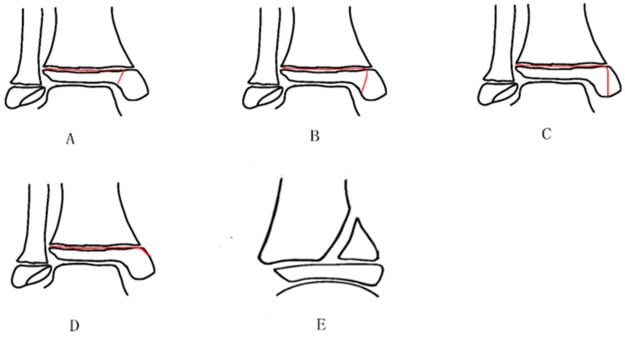 Five schematics of atypical triplane fracture lines, including intra-articular, extra-articular and medial malleolar variants.