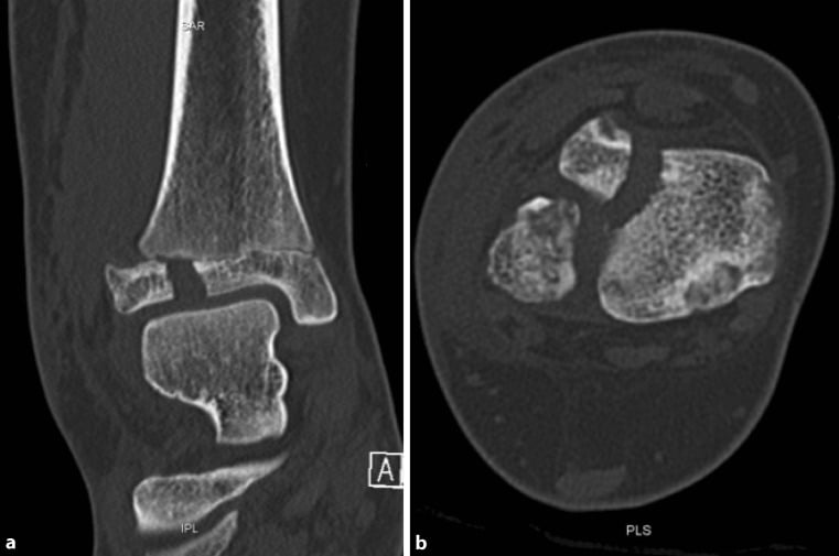 Coronal and axial CT images of a displaced juvenile Tillaux fracture with a widened articular gap.