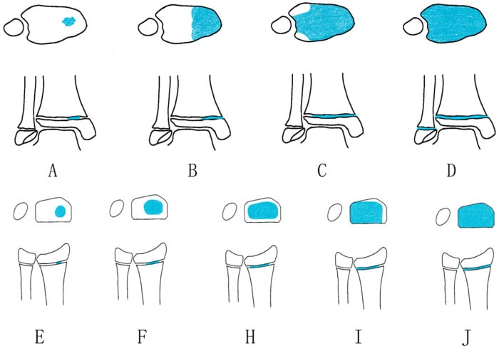 Serial axial and coronal schematics showing progressive distal tibial physeal closure from the central region toward the anterolateral physis.