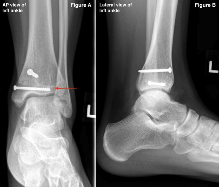 AP and lateral ankle radiographs showing a healed triplane fracture fixed with epiphyseal and metaphyseal screws.