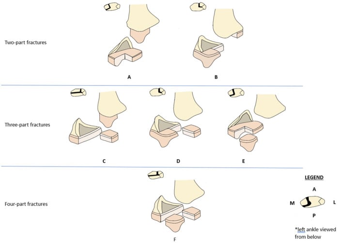 Exploded schematic classification of two-part, three-part and four-part distal tibial triplane fracture configurations.