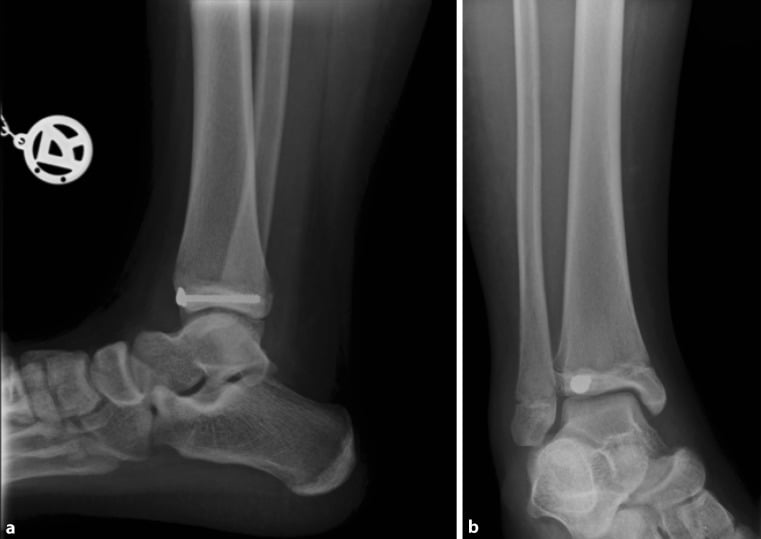 AP and lateral ankle radiographs after fixation of a juvenile Tillaux fracture with one epiphyseal screw.