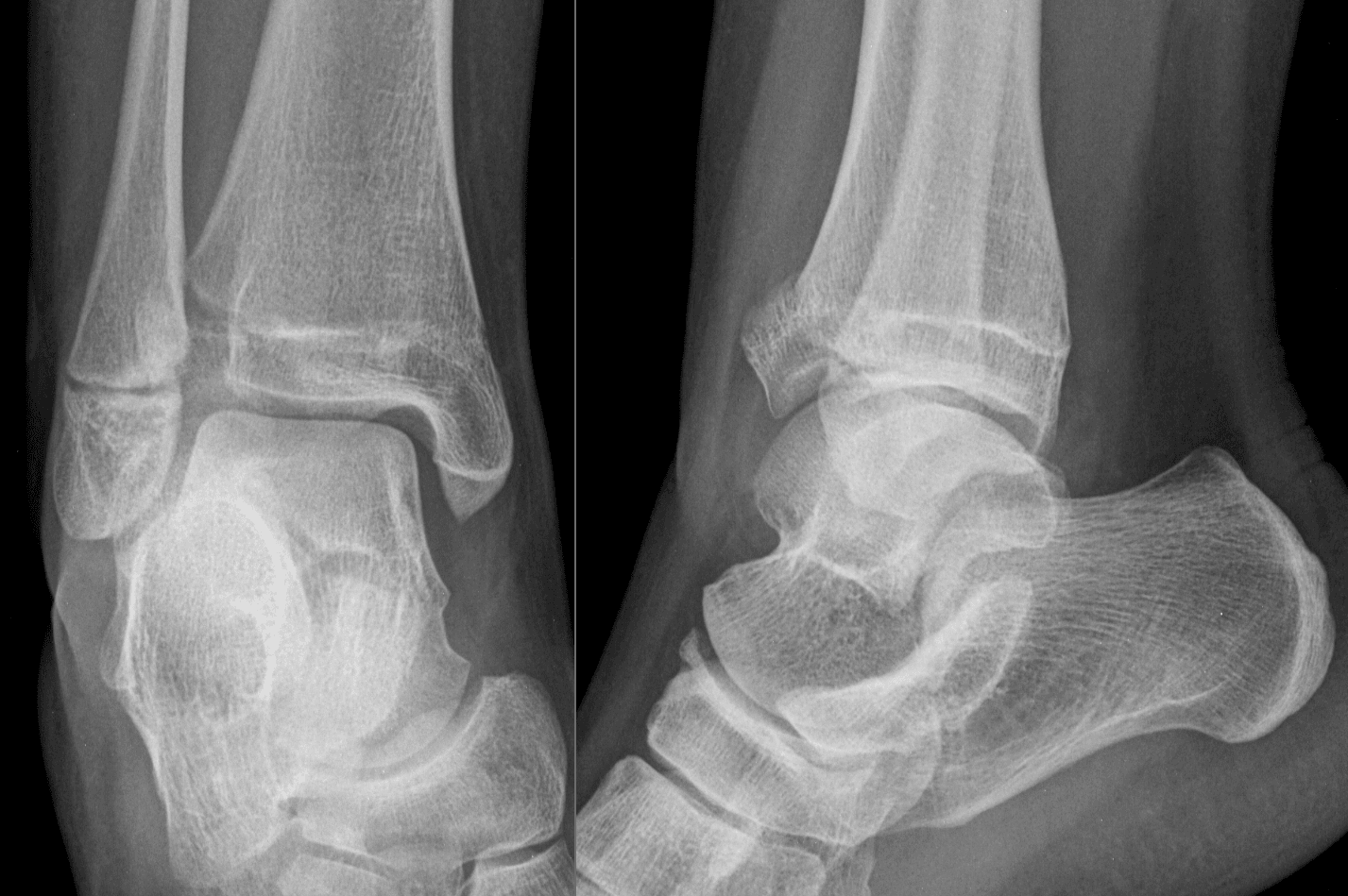 AP and lateral ankle radiographs of an adolescent showing a Salter-Harris III fracture of the anterolateral distal tibial epiphysis (juvenile Tillaux fracture).
