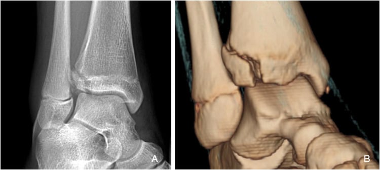 Mortise ankle radiograph and three-dimensional CT reconstruction of a displaced juvenile Tillaux fracture.