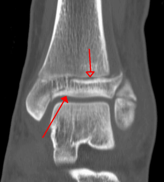 Coronal CT of the ankle showing the multi-plane fracture lines of a triplane fracture crossing the epiphysis, physis and metaphysis.