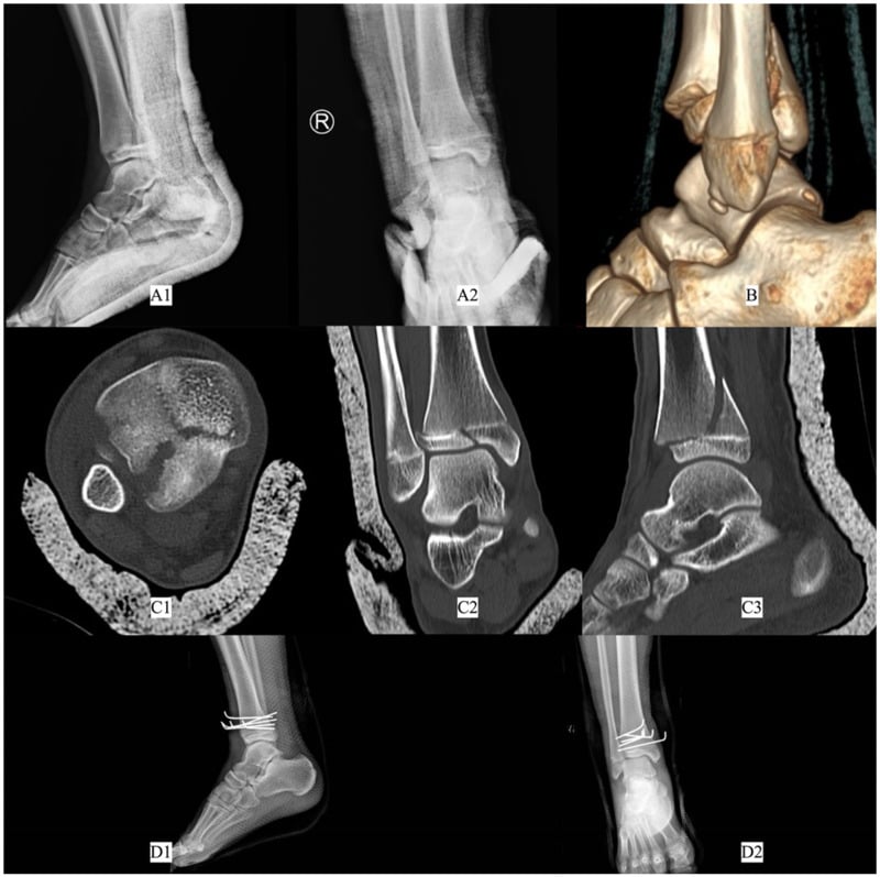 Composite showing triplane fracture radiographs, three-dimensional and multiplanar CT, and postoperative fixation.