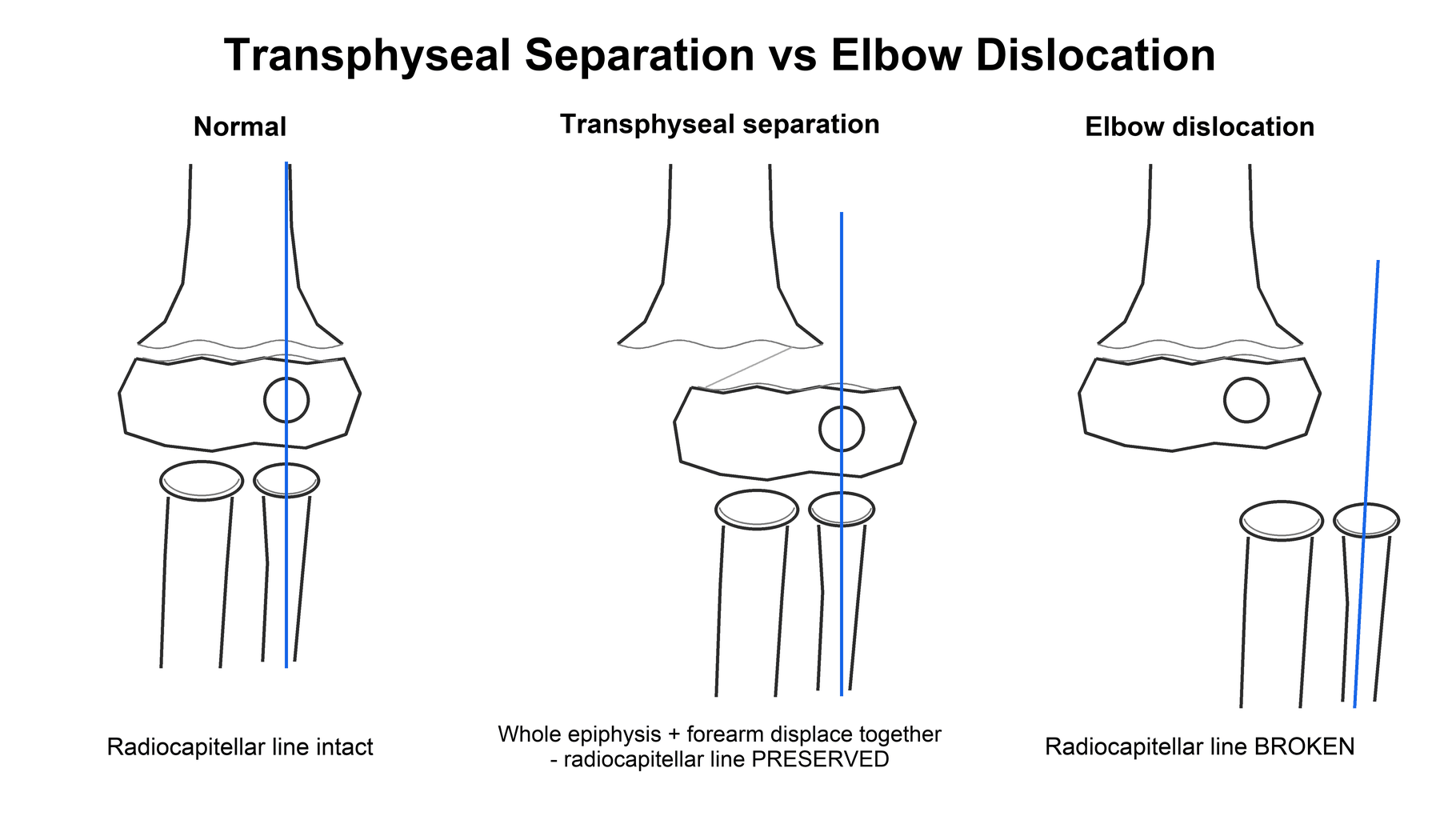 Three-panel diagram comparing a normal elbow, a transphyseal separation, and an elbow dislocation using the radiocapitellar line.