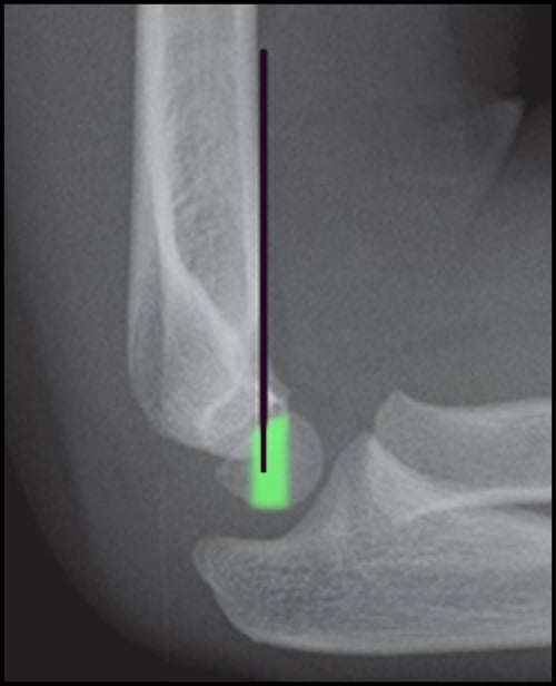 Lateral elbow radiograph of a 4-year-old with the anterior humeral line passing through the highlighted capitellum