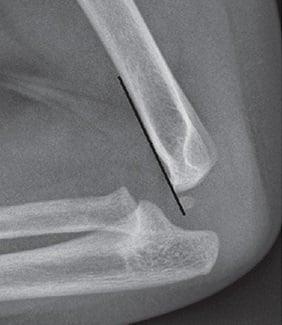 Elbow anatomy radiograph: lateral view of a normal 6-month-old elbow showing the largely unossified distal humeral epiphysis and physis (ossification structure) with the anterior humeral line drawn