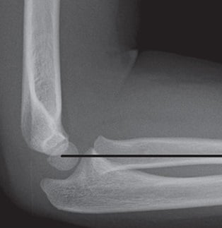 Lateral elbow radiograph with the radiocapitellar line drawn through the radial neck to the capitellum
