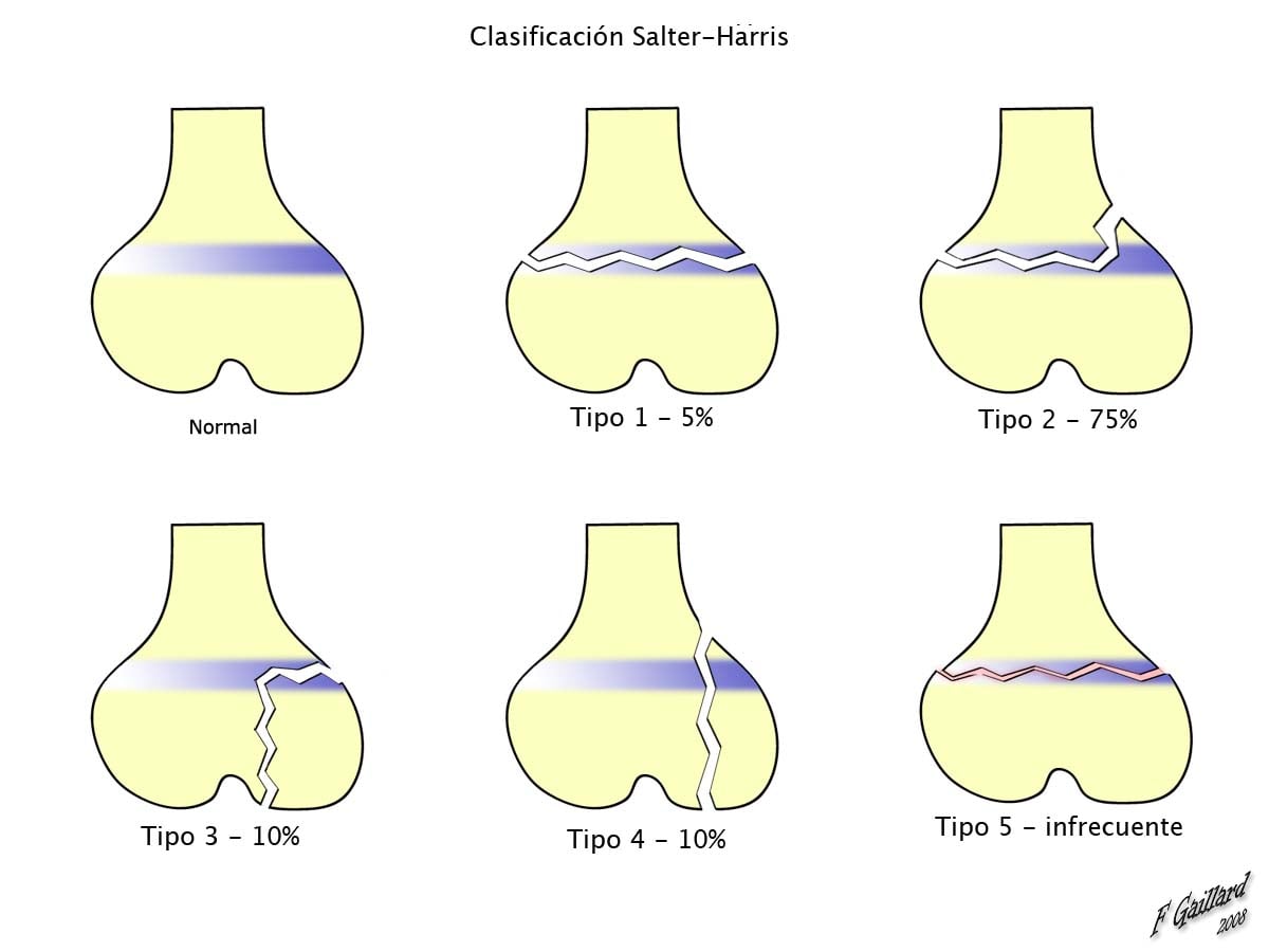 Salter-Harris classification diagram showing normal physis and types 1 to 5 of growth-plate fracture