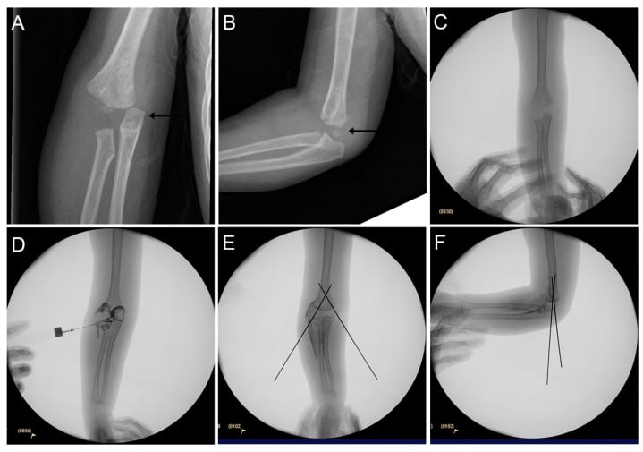 Intraoperative arthrogram and fluoroscopy of transphyseal distal humerus fracture closed reduction and K-wire pinning