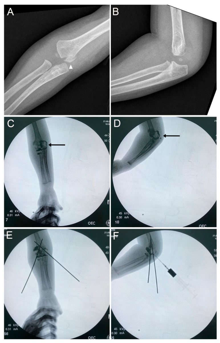 Radiographs and fluoroscopy of pediatric transphyseal distal humerus fracture K-wire pinning