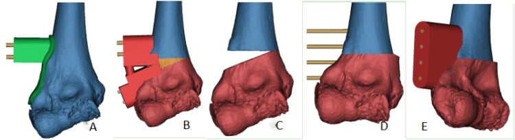 3D CAD simulation of 3D corrective osteotomy for cubitus varus deformity