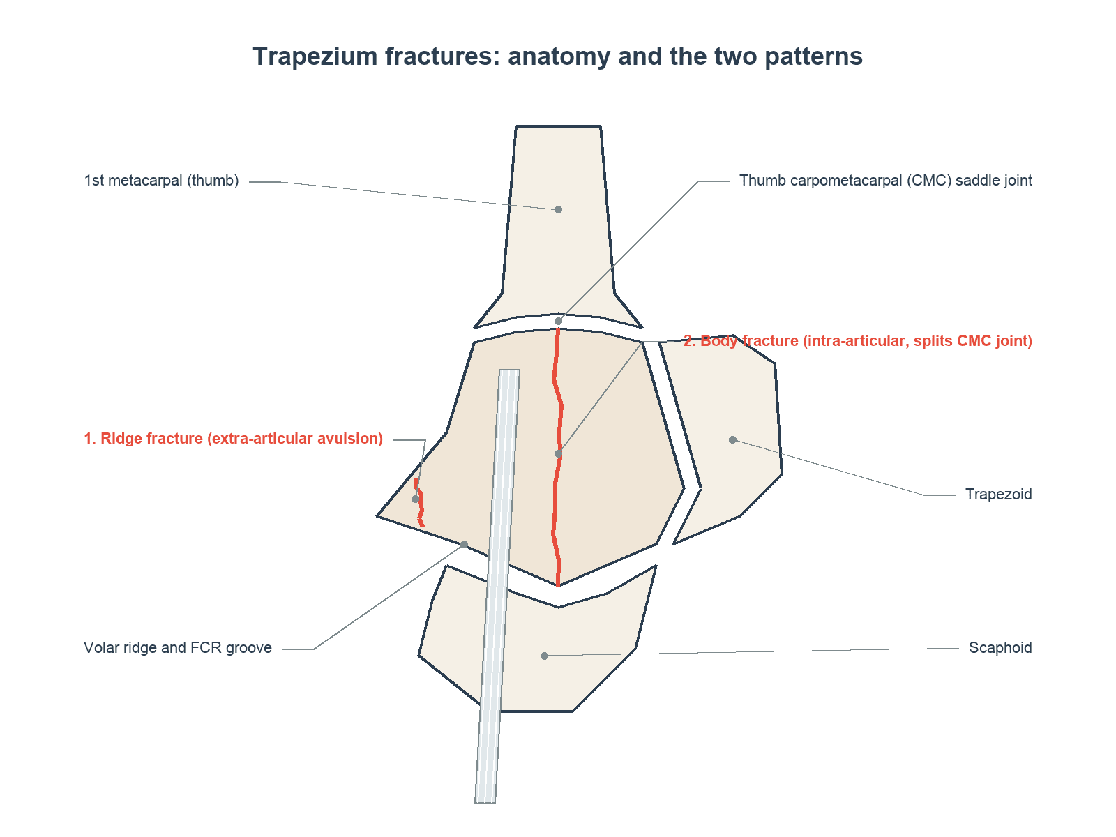 Diagram of trapezium anatomy showing the CMC saddle joint, volar ridge and FCR groove, and the two fracture patterns - extra-articular ridge avulsion and intra-articular body fracture