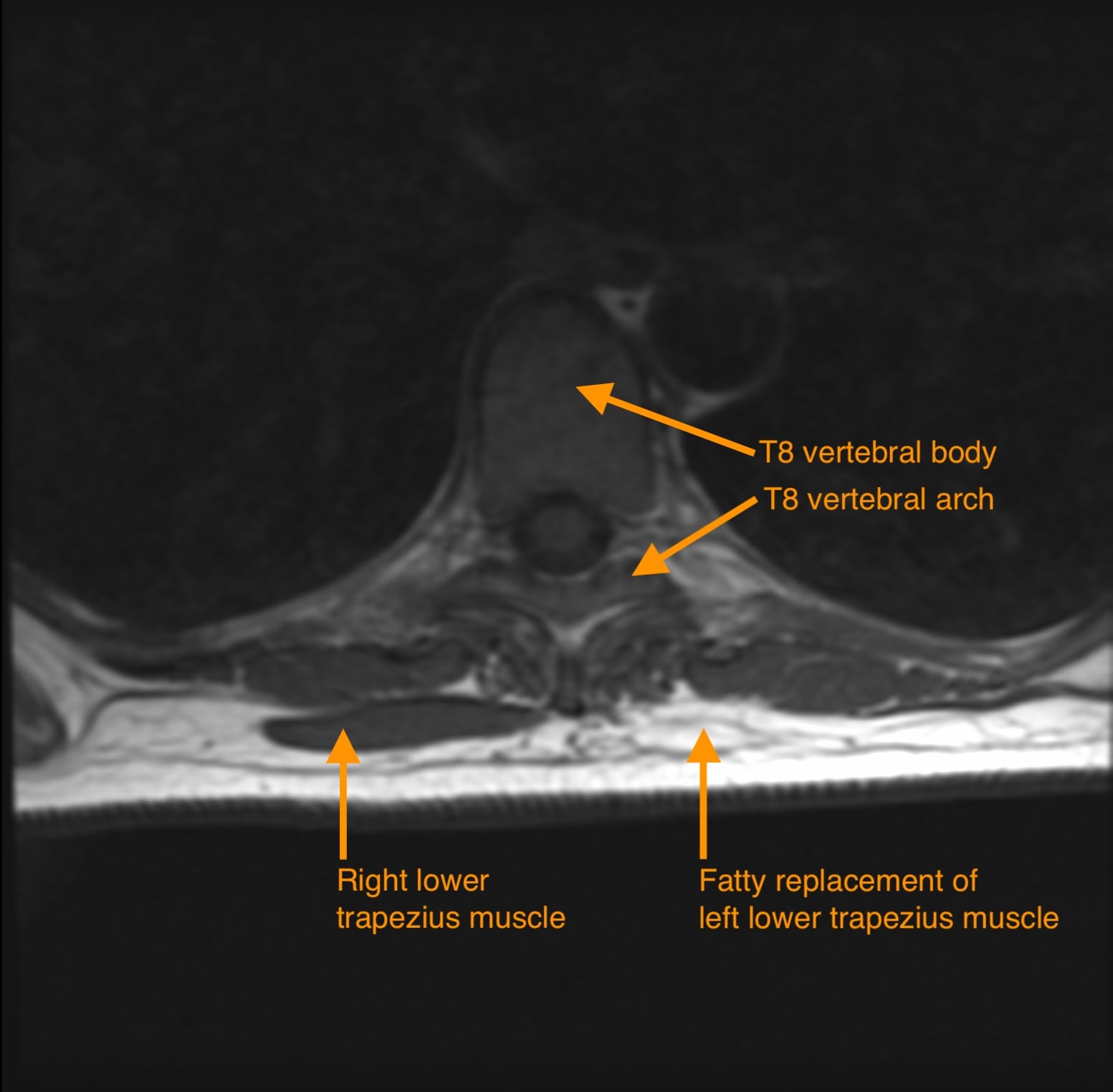 Axial T1-weighted MRI through the shoulders showing symmetrical fatty infiltration of trapezius bilaterally.