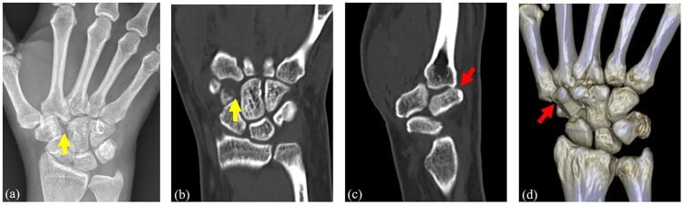 Radiograph and CT showing the missing carpal sign in trapezoid dislocation