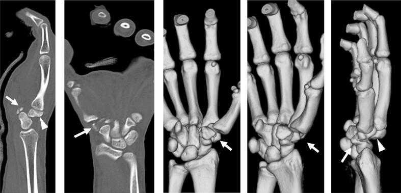 Axial and coronal CT demonstrating trapezoid fracture-dislocation