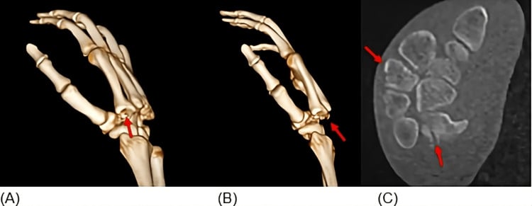 3D CT reconstruction confirming dorsal displacement of the trapezoid