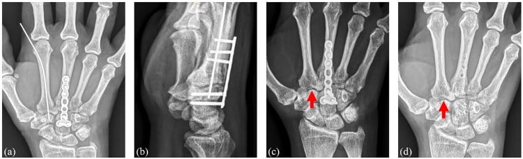 Postoperative PA and lateral radiographs demonstrating K-wire fixation of trapezoid