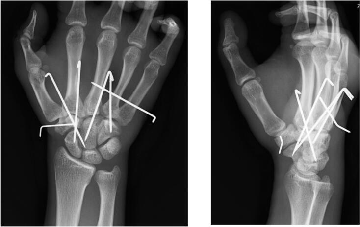 Postoperative PA radiograph demonstrating percutaneous K-wire pinning of trapezoid