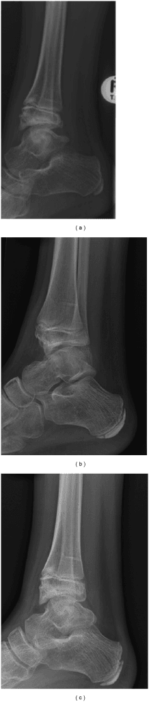 Ankle radiographs showing the abnormal epiphyseal bony anatomy of dysplasia epiphysealis hemimelica at the medial ankle