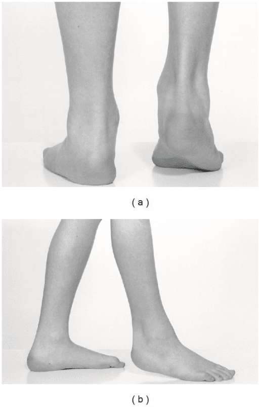 Clinical photographs of a child's lower legs and feet showing a medial ankle prominence