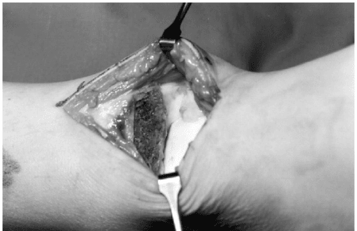 Intraoperative photograph of the resected osteocartilaginous lesion at the medial ankle