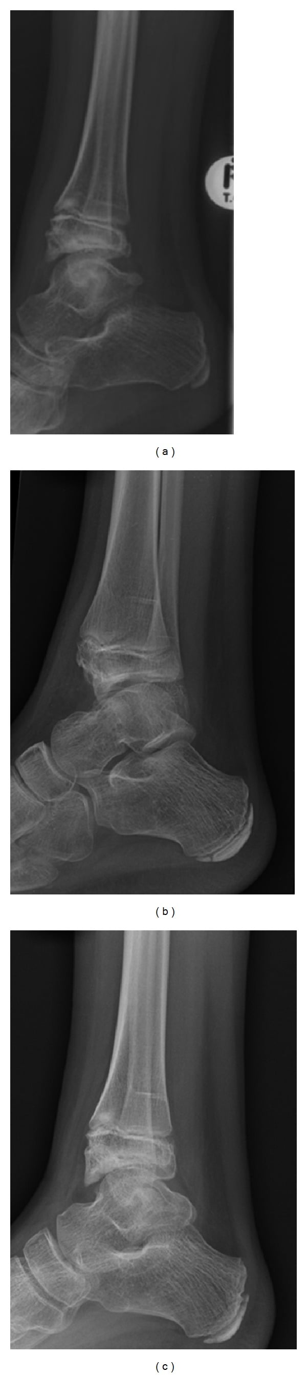 Serial ankle radiographs from 2005, 2008 and 2013 showing the lesion before and after excision