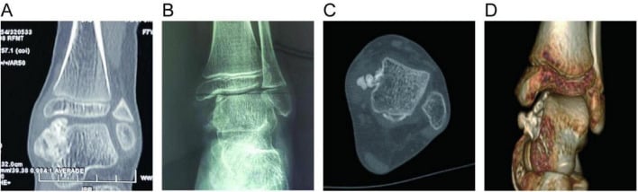 Plain CT, radiograph, axial CT and 3D reconstruction of a dysplasia epiphysealis hemimelica lesion of the talus