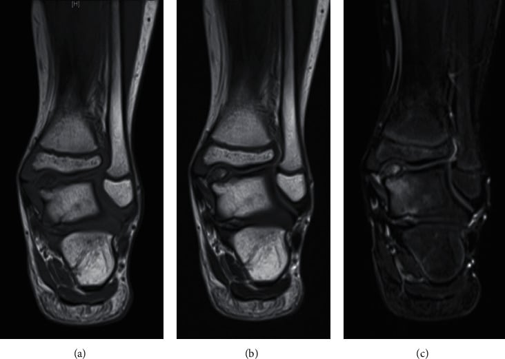 Coronal T1, T2 and STIR MRI of an epiphyseal cartilaginous mass
