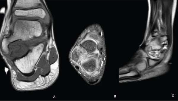 Coronal, axial and sagittal MRI showing a cartilaginous outgrowth arising from an epiphysis