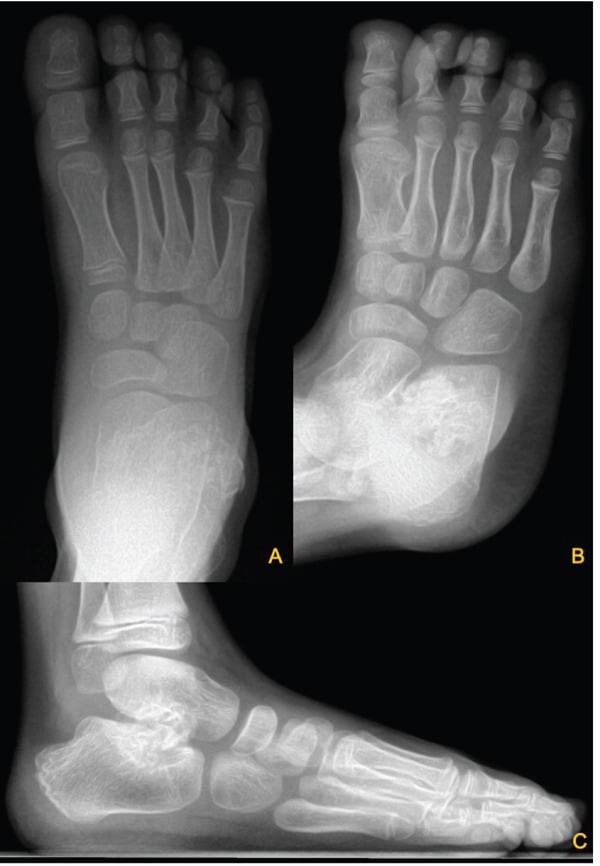 Anteroposterior, oblique and lateral foot radiographs showing a pedunculated osseous mass