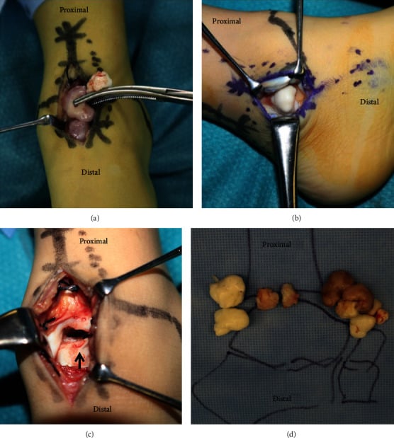 Intraoperative photographs of anterior and posteromedial approaches with removed intra-articular bodies