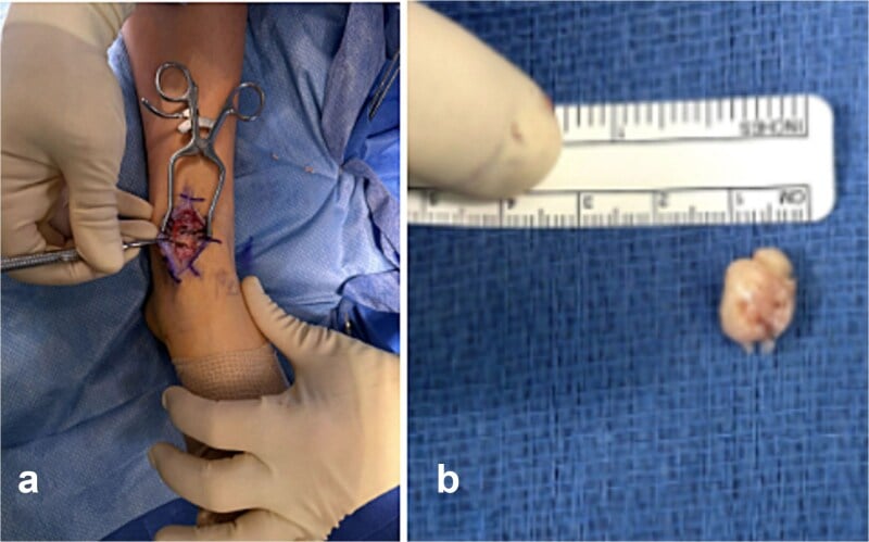 Intraoperative image of a talar osteochondroma causing mechanical impingement, with the excised specimen