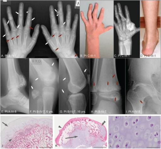 Hand radiographs, clinical photograph and histology showing metachondromatosis