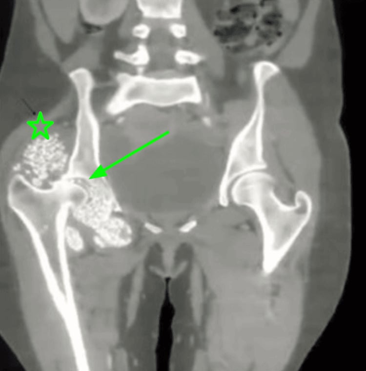 CT of the pelvis showing a large osteochondroma with secondary osteoarthritis