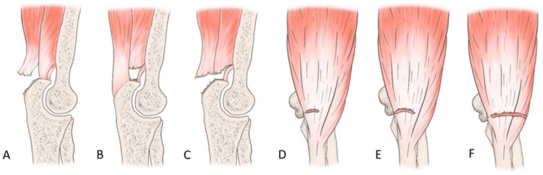 Classification illustration of superficial, deep and near-complete distal triceps tear patterns, panels A to C in sagittal section and D to F viewed from behind
