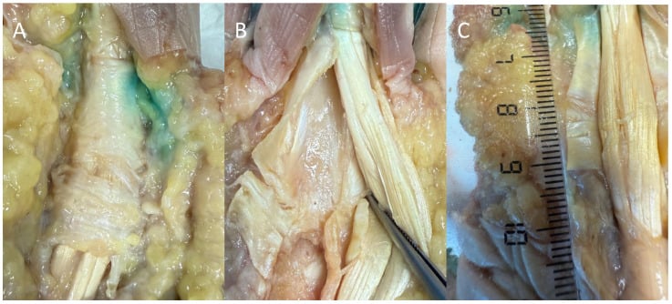 Cadaveric dissection of the flexor sheath and pulleys in three panels, with a ruler in panel C