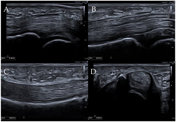 Ultrasound of the flexor pulleys in four panels, three long-axis and one short-axis, each with a calliper measurement