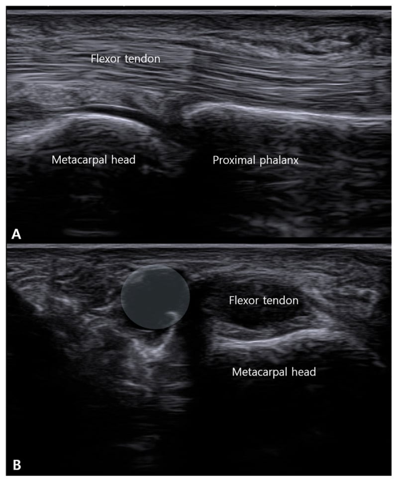Long-axis and short-axis ultrasound of an A1 pulley ganglion