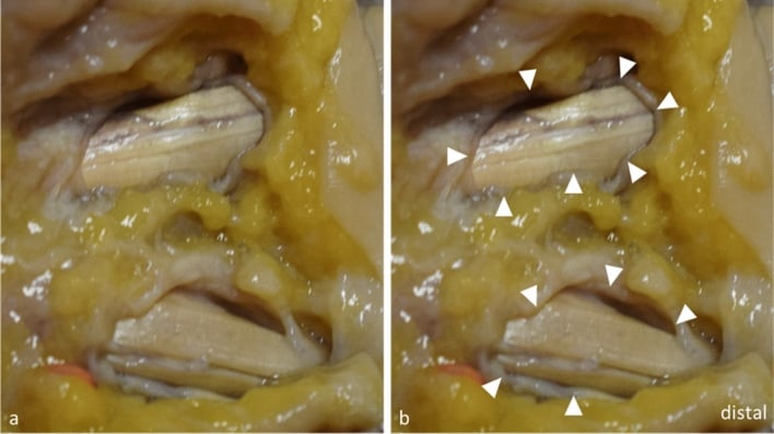 Cadaveric A1 pulleys after complete percutaneous transection, unmarked and with arrowheads