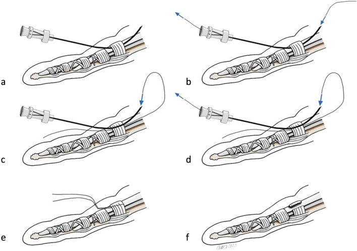 Six-step schematic of the thread-loop technique for percutaneous A1 release