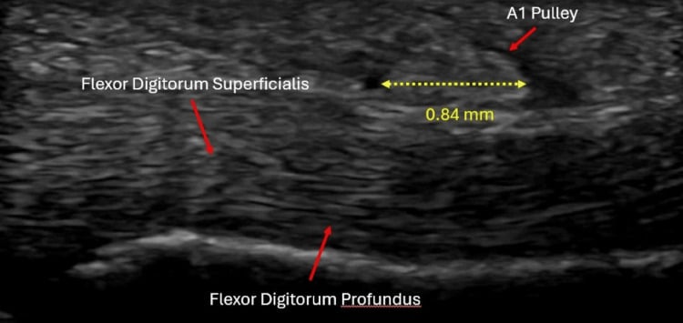Pre-procedure long-axis ultrasound of the A1 pulley over FDS and FDP with a calliper measurement of 0.84 mm