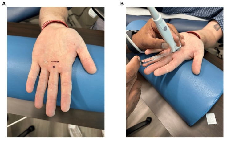 Surface marking on the palm and ultrasound-guided needle placement at the A1 pulley