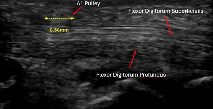 Follow-up long-axis ultrasound of the A1 pulley with a calliper measurement of 0.56 mm